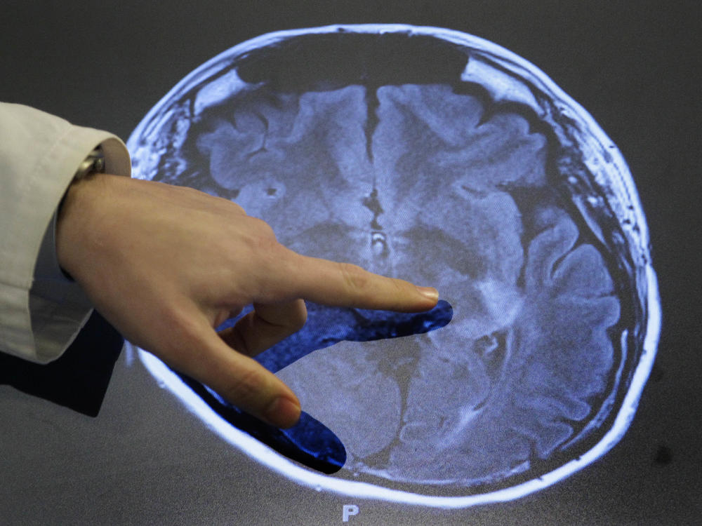 Dr. Paul Nyquist points to spots of possible damage caused by a stroke brain scan. Over the past 30 years, strokes among adults 49 and younger have increased in some parts of the U.S.
