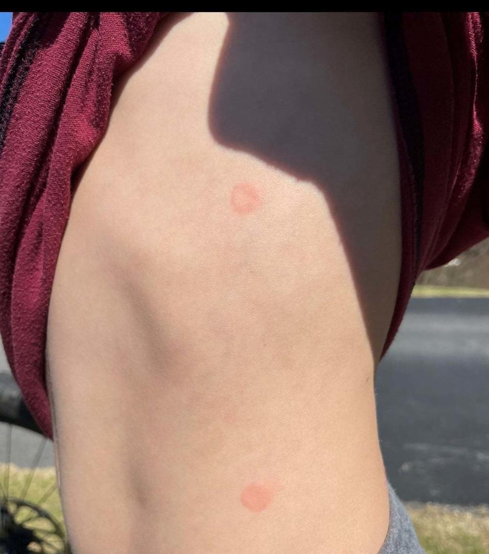 Police in Peachtree City, Ga., shared images on Facebook of a boy who was hit by modified Orbeez balls while riding his bike.