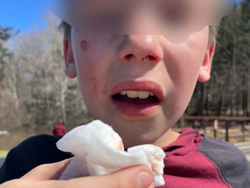 The Peachtree City Police Department in Georgia shared an image of a young boy bloodied by an alleged assault by teens participating in the Orbeez Challenge.