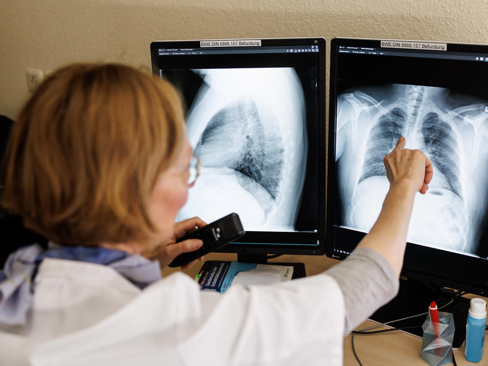 Refugees from Ukraine, which has a high rate of tuberculosis, are often screened for the disease. Above: Dr. Natalie Wöhrle analyzes the X-ray images of the lungs from a screening in Gauting, Germany, on March 12.