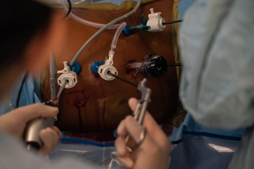 Dr. Mark Hobeika and surgical resident Shri Timdalia perform a kidney extraction surgery on a donor Lisa Jolivet.
