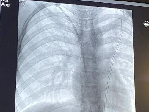 An X-ray of Mick Chivers' chest shows the central line inserted into his heart.