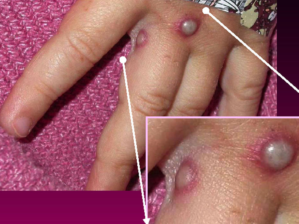 Symptoms of the monkeypox virus are shown on a patient's hand, from a 2003 case in the United States. In most instances, the disease causes fever and painful, pus-filled blisters. New cases in the United Kingdom, Spain and Portugal are spreading possibly through sexual contact, which had not previously been linked to monkeypox transmission.