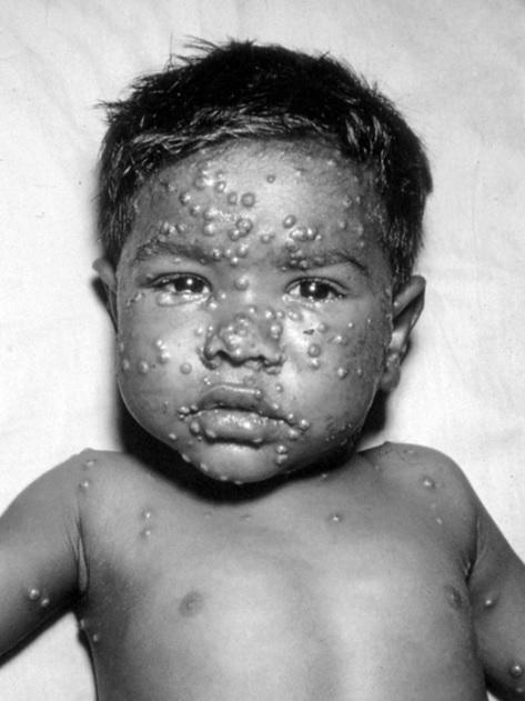 This was the image on a smallpox recognition card used by WHO in the 1970s to show people what smallpox looked like.
