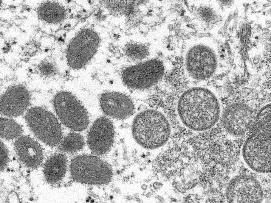 This 2003 electron microscope image made available by the Centers for Disease Control and Prevention shows mature, oval-shaped monkeypox virus particles, left, and spherical immature particles, right.