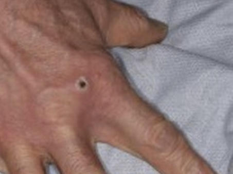 Above: a monkeypox lesion. The lesions in cases that are part of the 2022 outbreak are often first seen on genitalia or the anus. Spread to other parts of the body is possible but doesn't always occur.