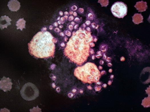 Dozens of <em>Leishmania</em> parasites (purple) surround 3 white blood cells (orange) in this image magnified 1,000 times.