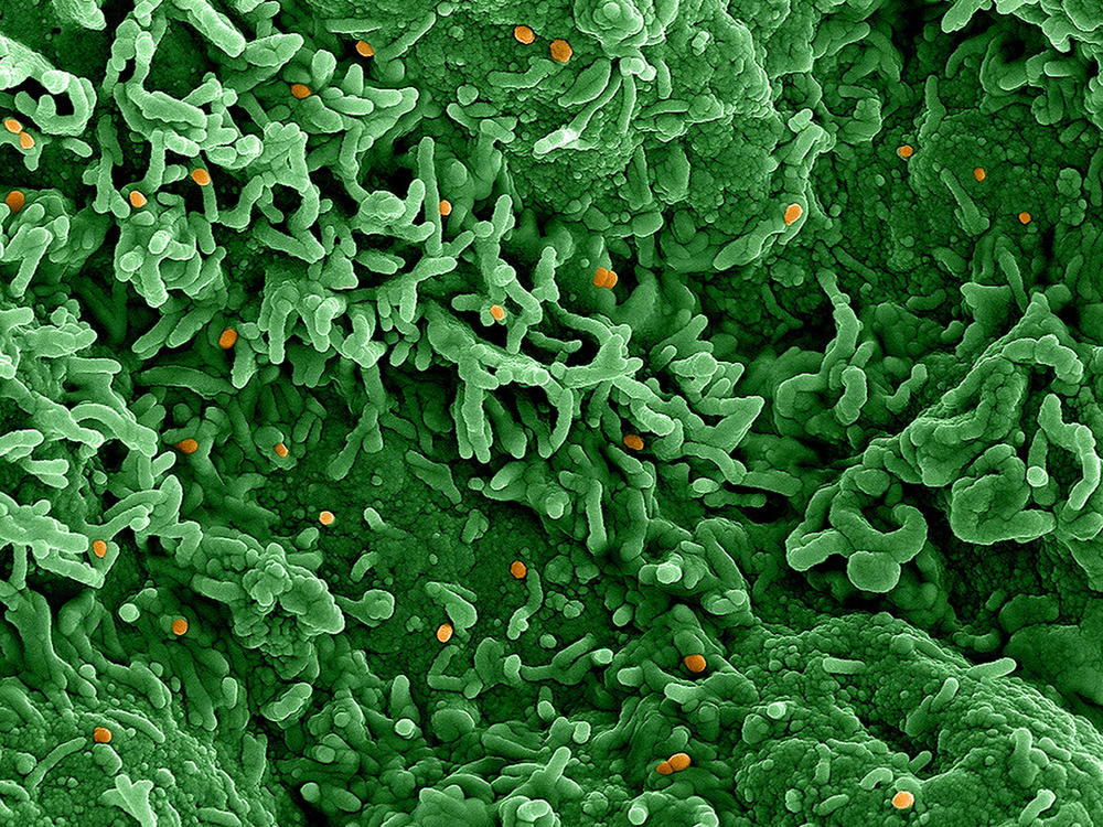 An image from an electron microscope of the monkeypox virus (orange) on infected cells (green).