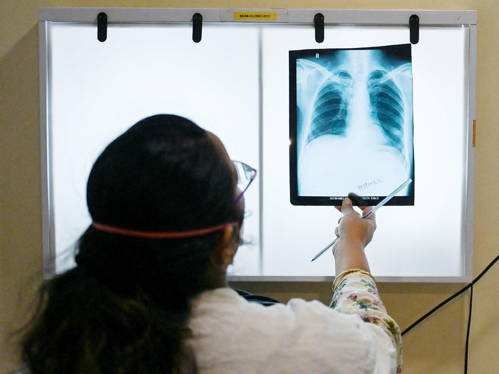 A doctor checks chest x-rays of a tuberculosis patient at a clinic in Mumbai, India, that treats those with drug-resistant strains of the disease. Two new studies look at how drug resistance might be overcome.