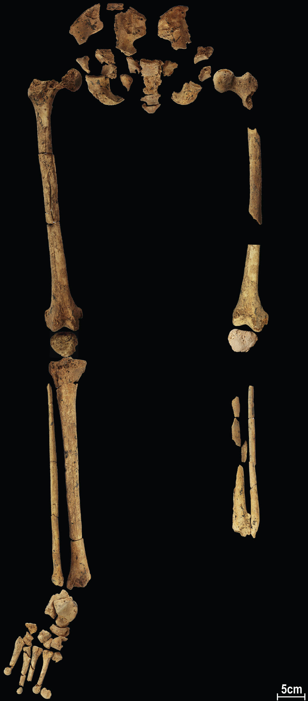 The skeleton discovered in a cave in  Indonesia could be evidence that humans were making medical advances much earlier than previously thought.