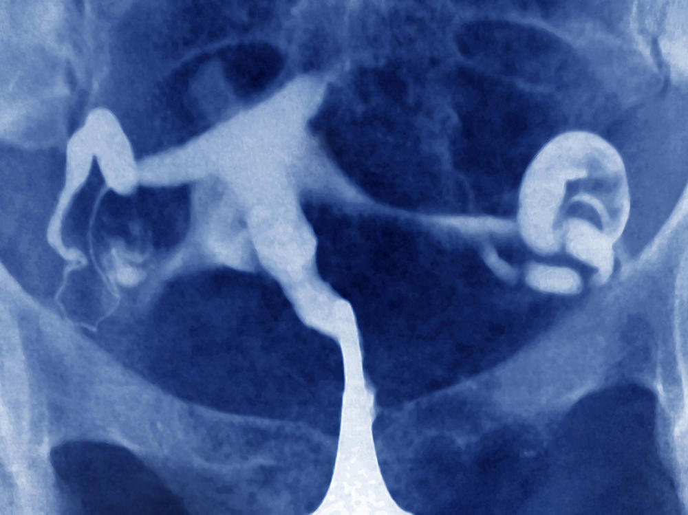 A color-enhanced scan of an ectopic pregnancy, which develops outside the uterus — often inside a fallopian tube. Such pregnancies are never viable and, unless ended, can lead to rupture of the tube, severe bleeding and even death.