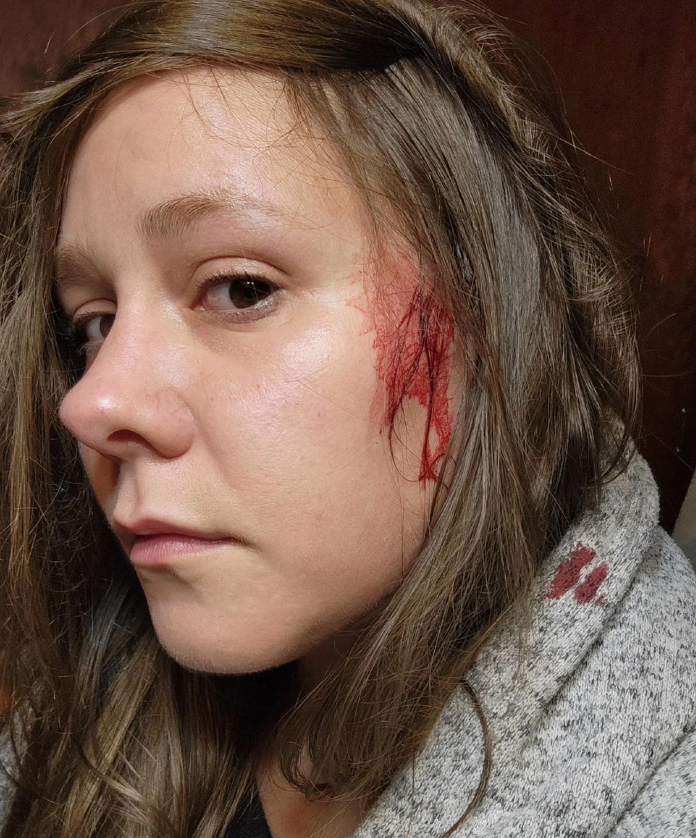 Kirsten Mathisen after one of her attacks by a barred owl.