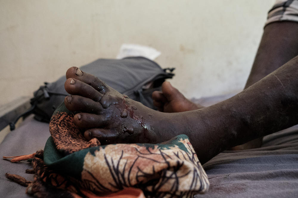 A viper bite on the leg of a 14 year old girl. If not treated fast enough, viper bites can lead to necrosis and amputation.