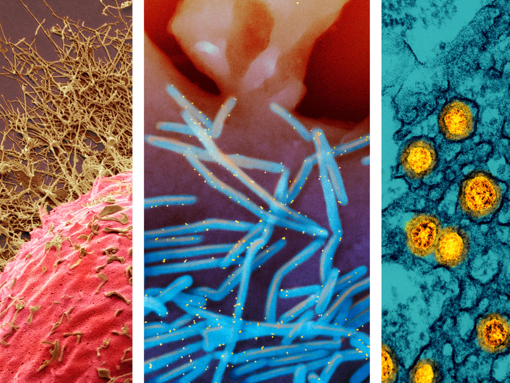 From left: 1) Colored scanning electron micrograph (SEM) of a human cell infected with H3N2 flu virus (gold filamentous particles). 2) Scanning electron micrograph of human respiratory syncytial virus (RSV) virions (colorized blue) that are shedding from the surface of human lung epithelial cells. 3) Transmission electron micrograph of SARS-CoV-2 Omicron virus particles (gold).
