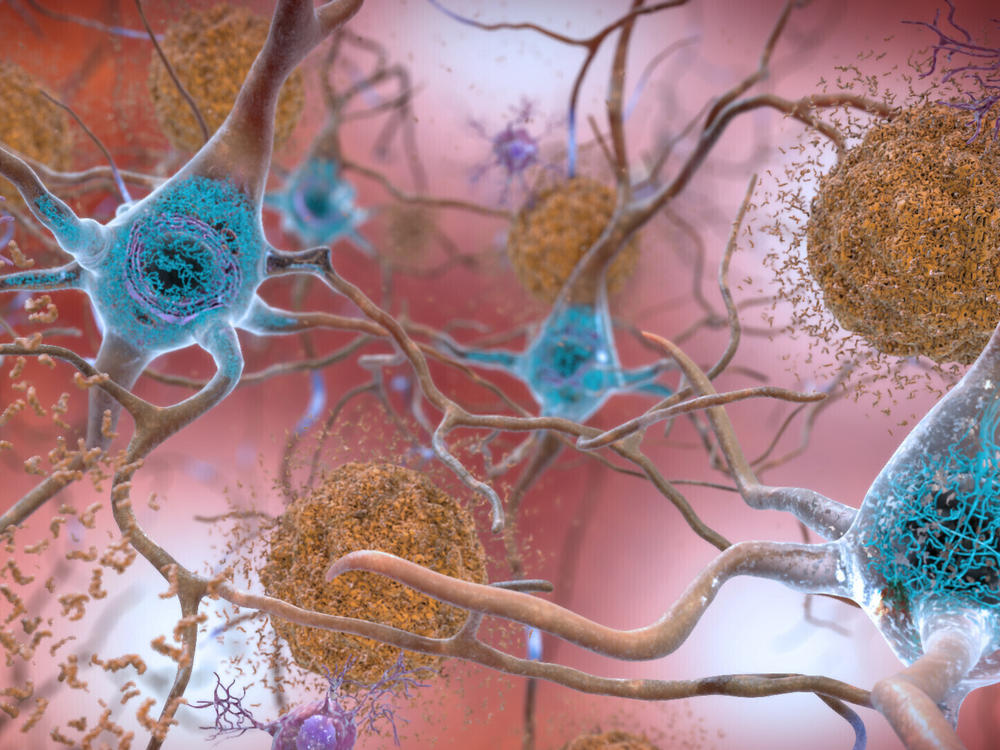 This illustration made available by the National Institute on Aging/National Institutes of Health depicts cells in an Alzheimer's-affected brain. An experimental drug modestly slowed the brain disease's progression, researchers reported Tuesday.