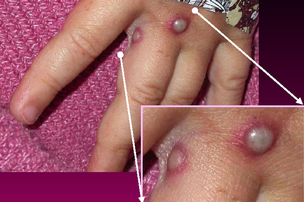Symptoms of the monkeypox virus are shown on a patient's hand, from a 2003 case in the United States. In most instances, the disease causes fever and painful, pus-filled blisters. New cases in the United Kingdom, Spain and Portugal are spreading possibly through sexual contact, which had not previously been linked to monkeypox transmission.