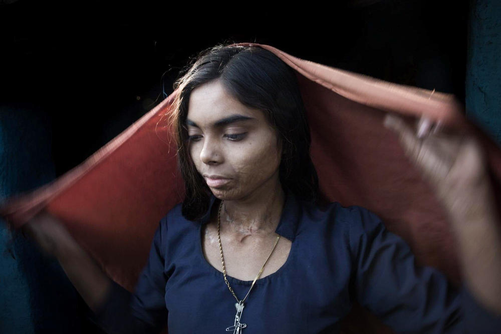 A portrait of Savitri in December 2016, showing her scars from burns sustained when she was lighting her family's coal oven when she was 13.<strong> </strong>She is one of the young people who scavenge for coal from the Ghansadih mine.