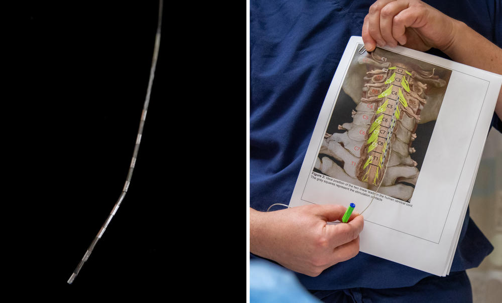 (Left) A close-up of a stimulating electrode containing eight stimulation contacts. (Right) Gerszten explains the placement of stimulating electrodes while holding one in his hand.