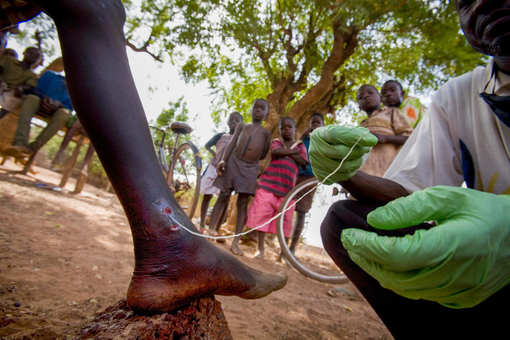 Medical worker Abaare Hussein extracts a Guinea worm from a child's leg in Savelugu Village in northern Ghana in 2007.