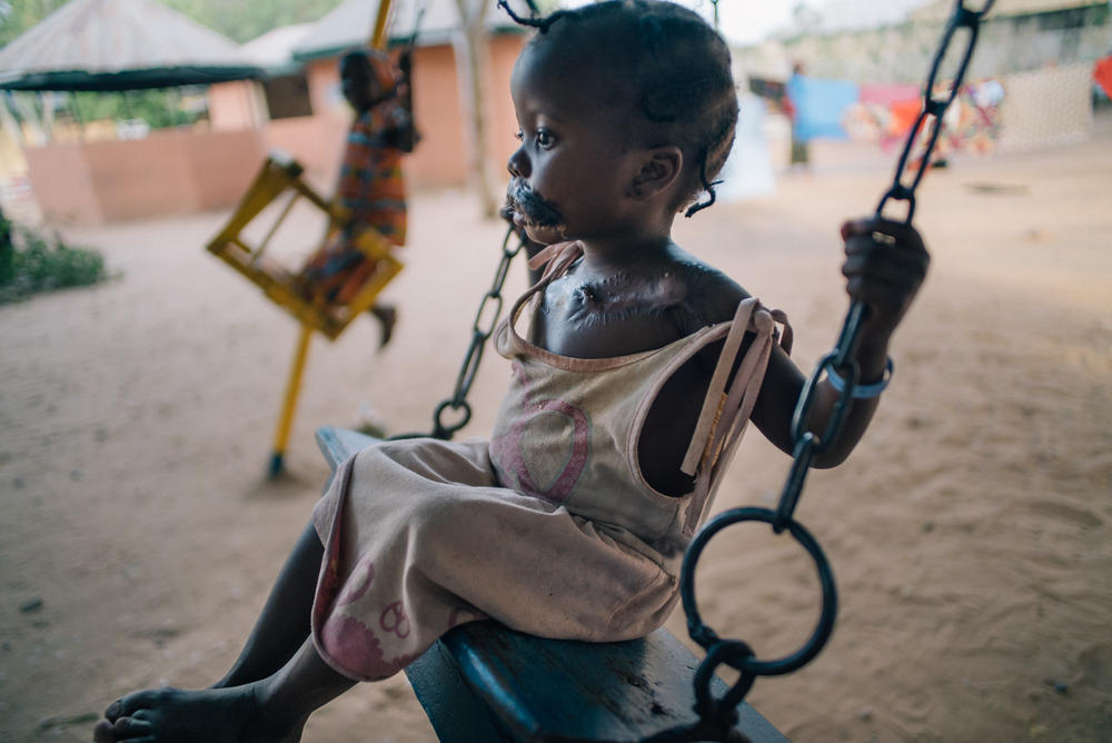 A young girl in the courtyard of Nigeria's Sokoto Noma Hospital. She arrived with her mother for reconstructive operations, including a skin graft taken from her chest to replace tissue destroyed by noma.