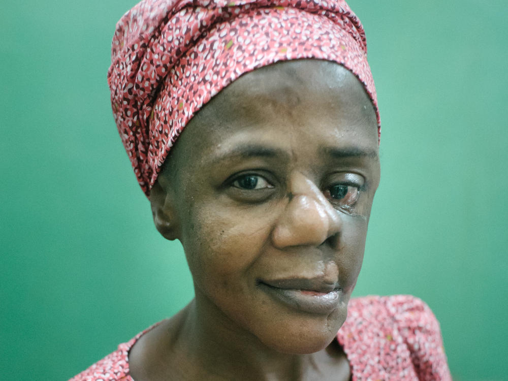 Mulikat Okanlawon of Nigeria contracted noma when she was a child. The gangrenous infection ate away at the flesh and bone in her face. She survived and has had surgery to repair scars left by the disease. Today she works at the Sokoto Noma Hospital, guiding noma patients on the road to recovery.