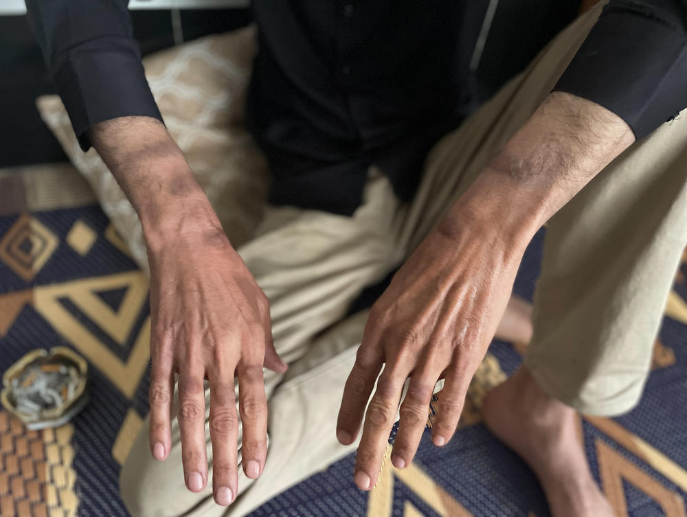 Talib al-Majli shows scars on his arms from where he bites his own skin. It's a nervous tic he says he developed in Abu Ghraib that continues to this day.