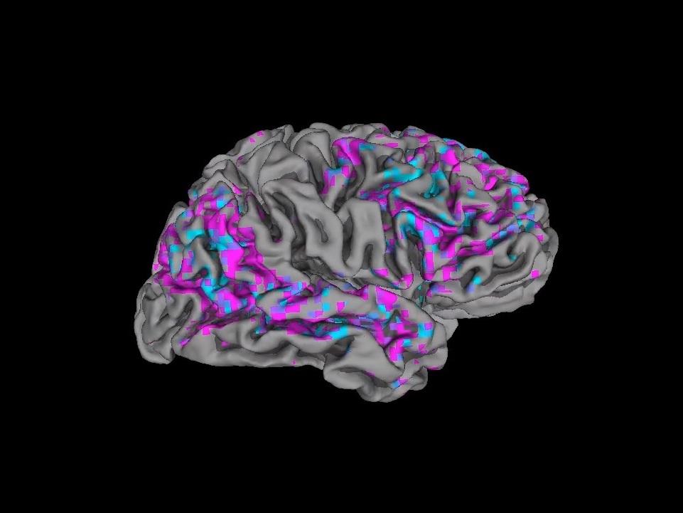 This video still shows a view of one person's cerebral cortex. Pink areas have above-average activity; blue areas have below-average activity.