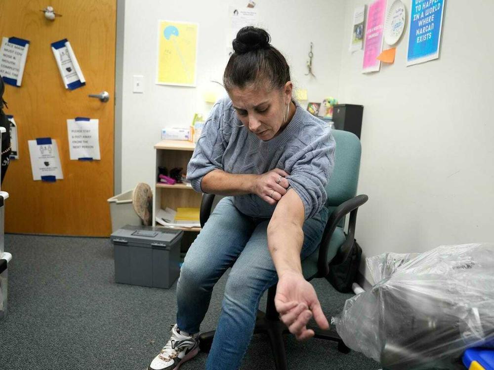 Amy Treglia shows scarring on her arms caused by xylazine, a veterinary tranquilizer that is being used as a cutting agent for heroin and fentanyl.