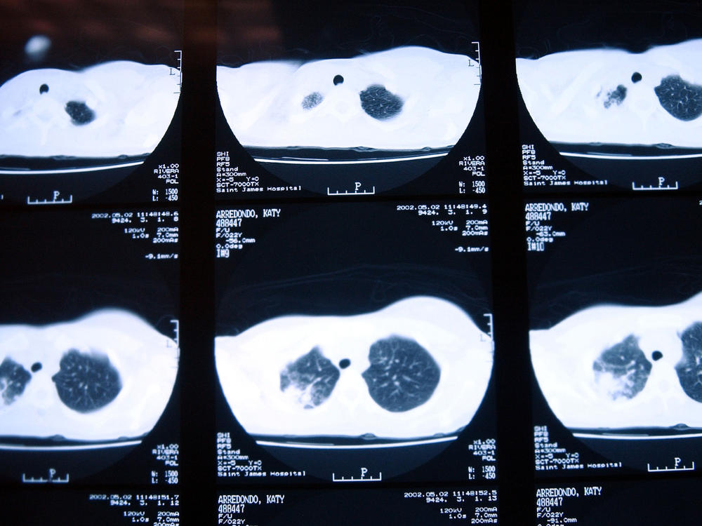 X-rays of a patient with tuberculosis, taken in November 2002 in New Jersey, show damage to the lungs.