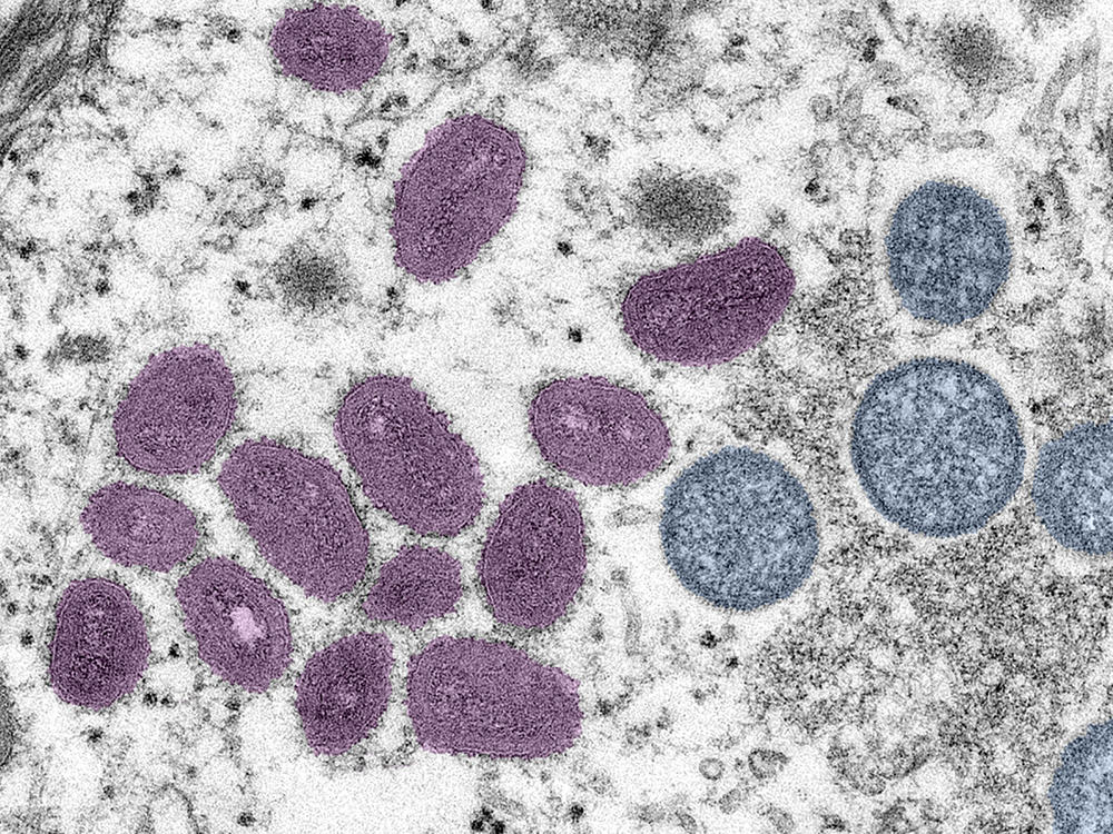 An electron microscopic image of mpox virus particles. The mpox emergency of last summer is over. Was it a passing threat? Or is there reason to believe another global outbreak could happen.