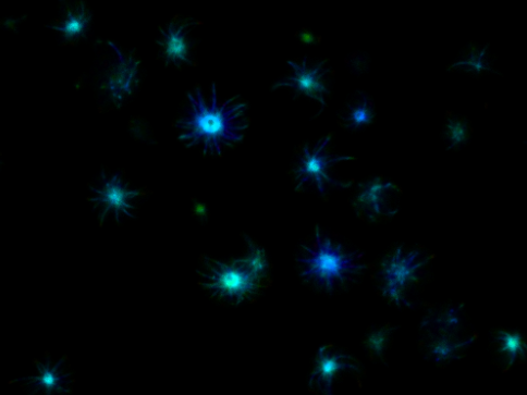In Huntington's disease, proteins form toxic clumps that kill brain cells.