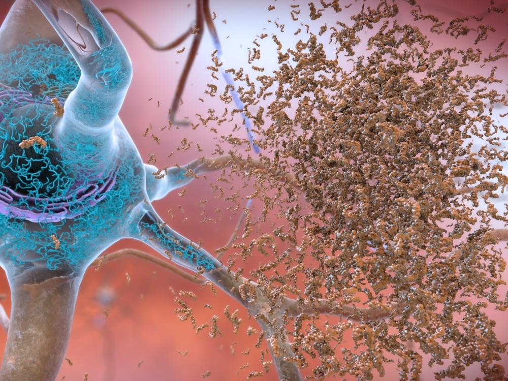 In patients with Alzheimer's disease, a substance called beta-amyloid can form toxic clumps in between neurons. Drugs like lecanemab are designed to remove amyloid-beta from the brain.