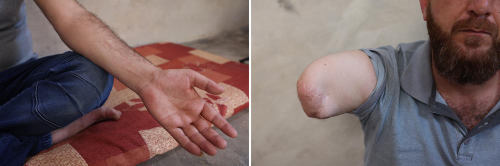 Barakat Ahmad Barakat shows the injuries he sustained from the U.S. airstrikes. His right hand was blown off, and the arm was amputated. He got surgery this year to remove shrapnel from his left arm.