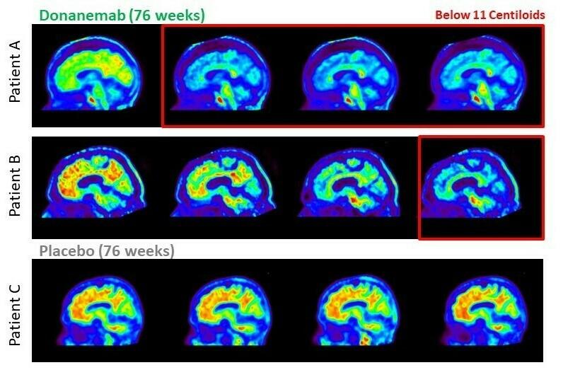 The image shows amyloid plaques in the brains of three patients in the early stages of Alzheimer's. Those plaques are greatly reduced in the first two patients, who got donanemab, but remain unchanged in a patient who received no treatment.