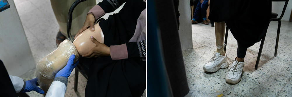 Left: The doctor, Muna Hasan, adjusts Shaimaa Ali Ahmed's prosthetic before she begins physical therapy. Right: Ali Ahmed stands on the adjusted prosthetic to begin. The clinic lacks limbs with knee joints.