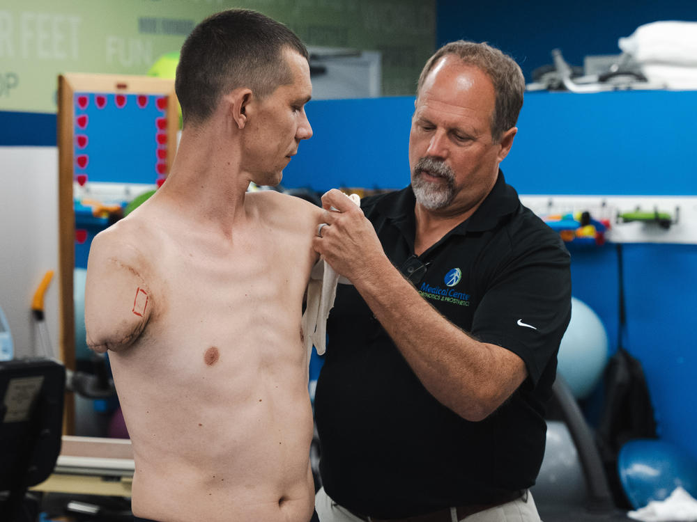 James Vandersea, the lead upper-extremity prosthetics specialist at Medical Center Orthotics and Prosthetics, works with Ukrainian soldier Ilya Mykhalchuk on July 24 in Silver Spring, Md. Russia's war in Ukraine has resulted in thousands of people with amputations, many of whom have complex cases that are more difficult and expensive to care for.