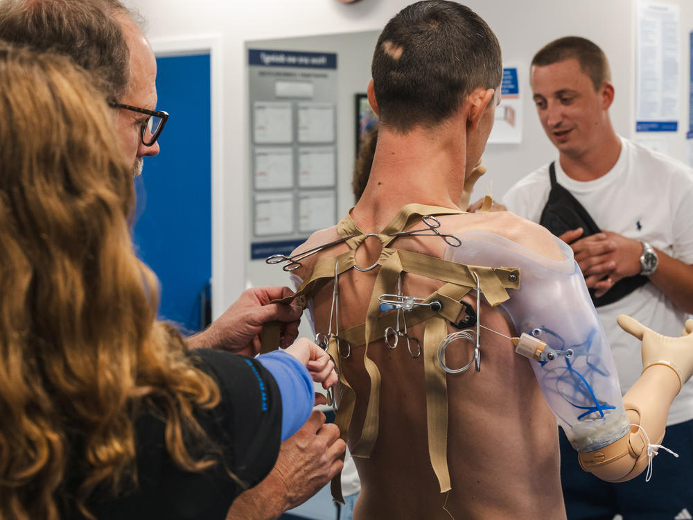 Prosthetics specialist James Vandersea (left) works to fit Ilya Mykhalchuk with prosthetic arms on Aug. 2. Prostheses range drastically in price depending on the complexity of the device. Some can cost well over $100,000.