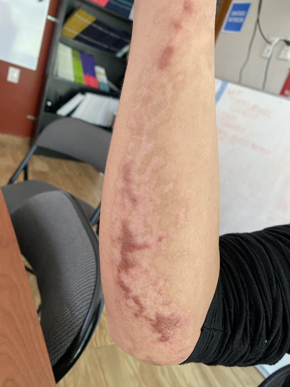 A survivor's scars from the fire at the immigration detention center of the National Migration Institute in Ciudad Juárez, Mexico.