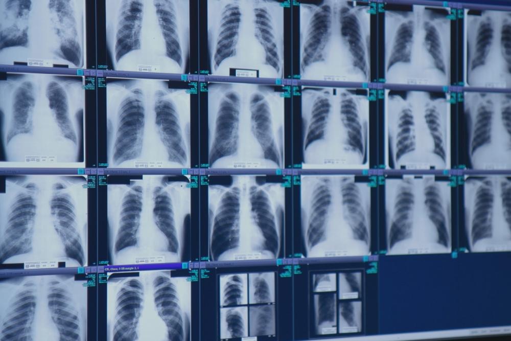 Lungs riddled with fibrotic tissue from complicated black lung disease are displayed in the office of radiologist Brandon Crum in Pikeville, Ky.