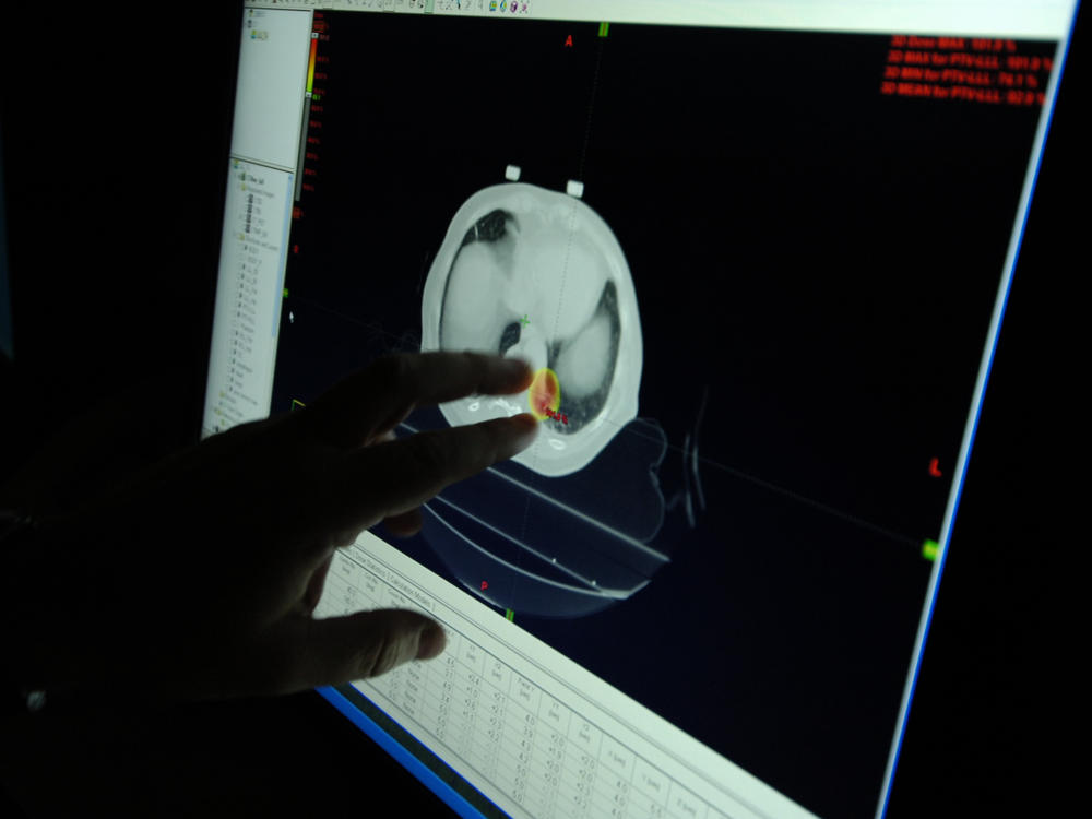 A doctor assesses a radio surgery treatment plan for a patient with lung cancer, using a 4D CAT scan. Lung cancer survival rates have increased lately.