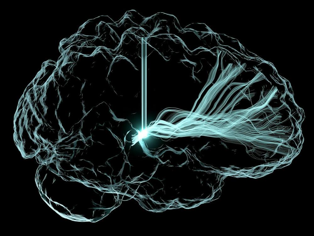 An artistic rendering of deep brain stimulation. Scientists are studying this approach to see if it can treat cognitive impairment that can arise after a traumatic brain injury and other conditions.