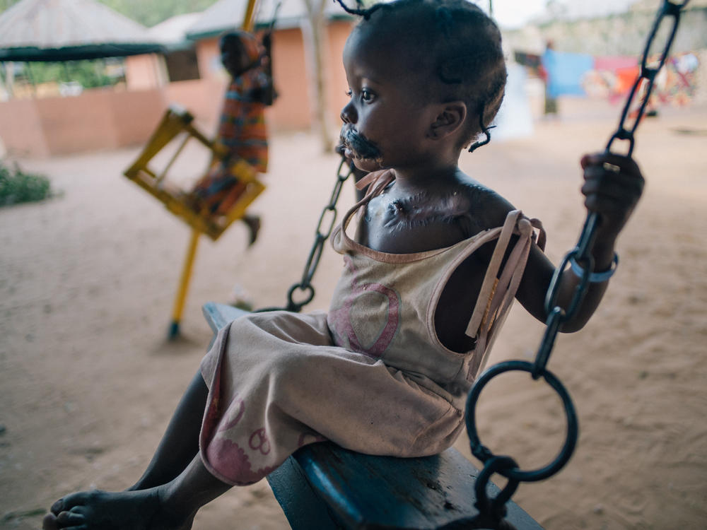 A young girl in the courtyard of Nigeria's Sokoto Noma Hospital. She arrived with her mother for reconstructive operations, including a skin graft taken from her chest to replace tissue destroyed by noma.