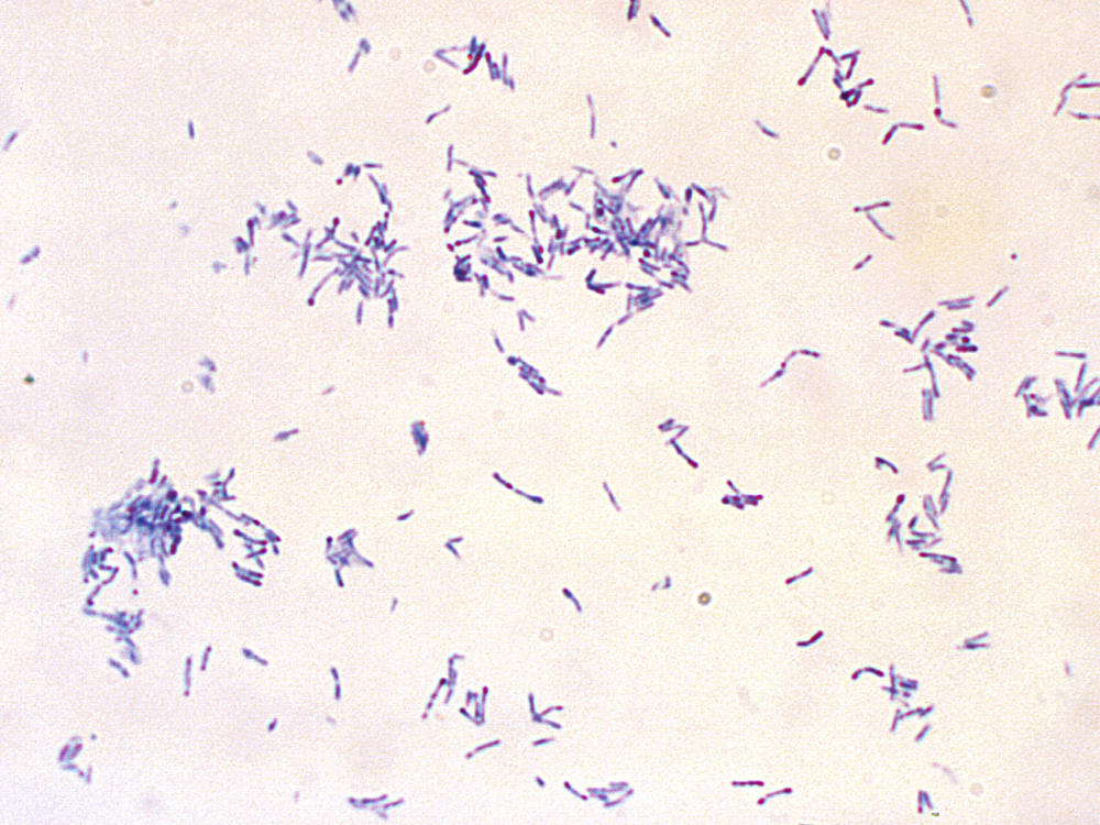 The potentially fatal disease diphtheria is caused by bacteria — the club-shaped, Gram-positive, Corynebacterium diphtheriae bacilli shown in this microscope photo.