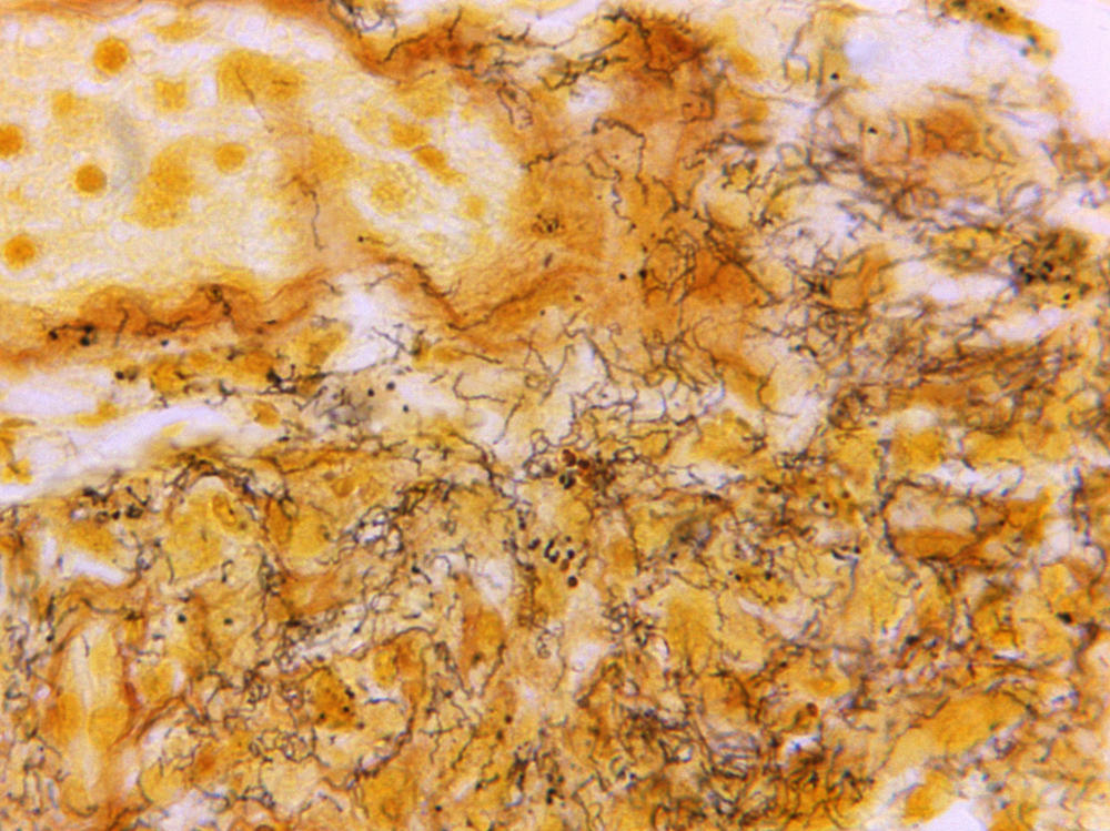 This 1966 microscope photo made available by the Centers for Disease Control and Prevention shows a tissue sample with the presence of numerous, corkscrew-shaped, darkly-stained, Treponema pallidum spirochetes, the bacterium responsible for causing syphilis.