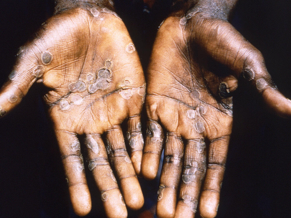The palms of a patient with mpox during a past outbreak in the Democratic Republic of Congo in 1997. The country is now seeing a dramatic spike in mpox.