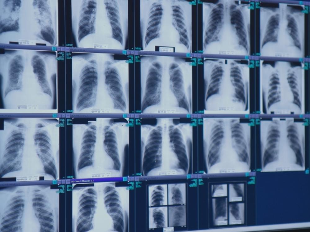 The safety rules being announced and finalized today will hold mines to the same standard for silica dust exposure as other employers. These x-rays show black lung disease.
