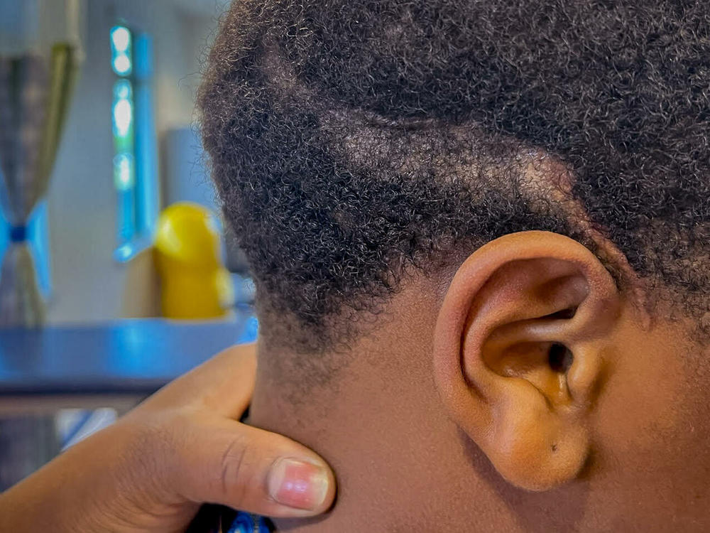 A twisting scar left behind after a bullet entered Aaron Hunter's brain on June 22, 2023. After emergency surgery at Johns Hopkins All Children's Hospital in St. Petersburg, Florida, the surgeon warned that the 13-year-old's ability to walk, see and speak could be affected. He spent weeks in the hospital followed by eight months of physical and occupational therapy.