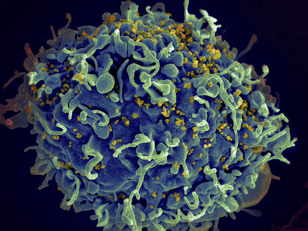This electron microscope image made available by the U.S. National Institutes of Health shows a human T cell, in blue, under attack by HIV, in yellow, the virus that causes AIDS.
