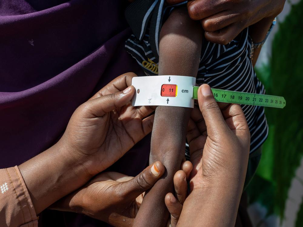 A child is checked for malnutrition by a health worker at Kahda IDP camp near Mogadishu, Somalia. Most young kids arrive with severe malnutrition, and some die. Thousands of people have fled her home due to a long drought and armed conflict in the region
