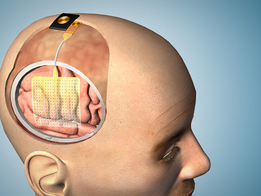 This illustration shows how the thin film of sensors could be applied to the brain before surgery. 